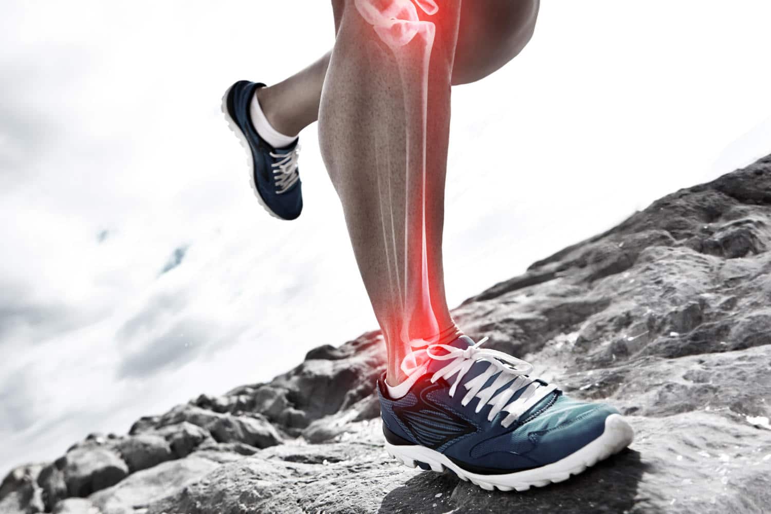 Infortuni legati alla corsa Parte 4: lesioni muscolari e sindrome da stress tibiale