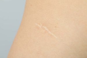 Trattamento delle cicatrici con l'ergoterapia a Lugano Paradiso
