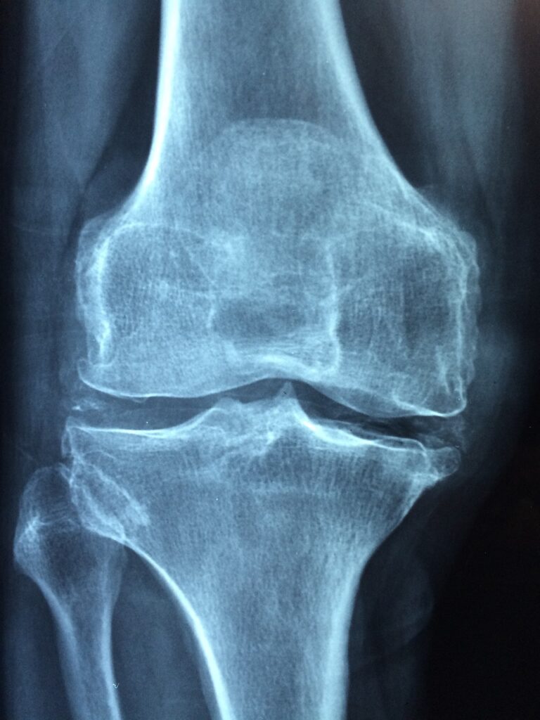 Artrosi ed ergoterapia in questa foto un esempio con lastra al ginocchio